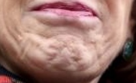 Carly Fiorina Chin Cellulite