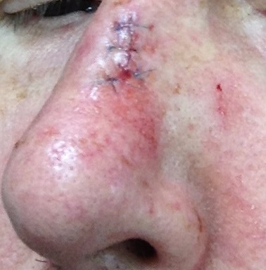 nose stitches