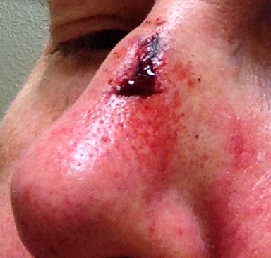 nose wound