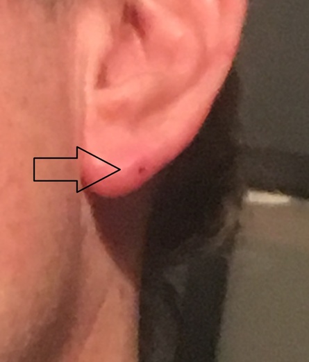 ear small