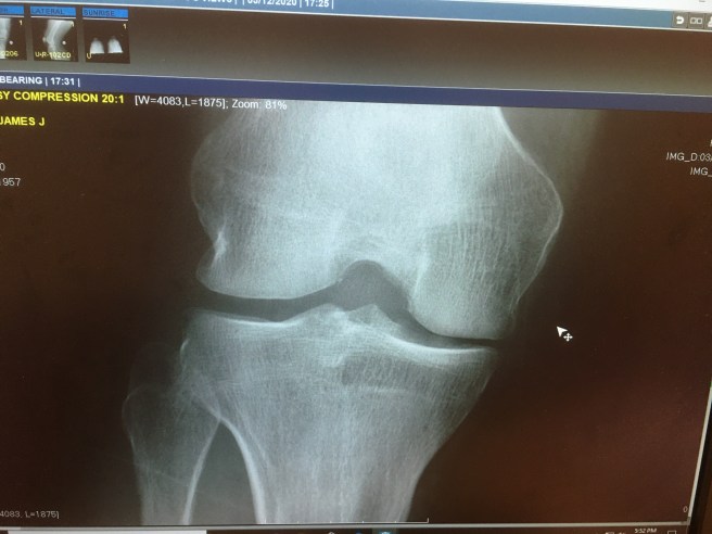 Knee x-ray
