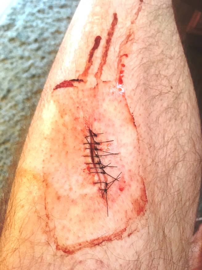 Leg stitches