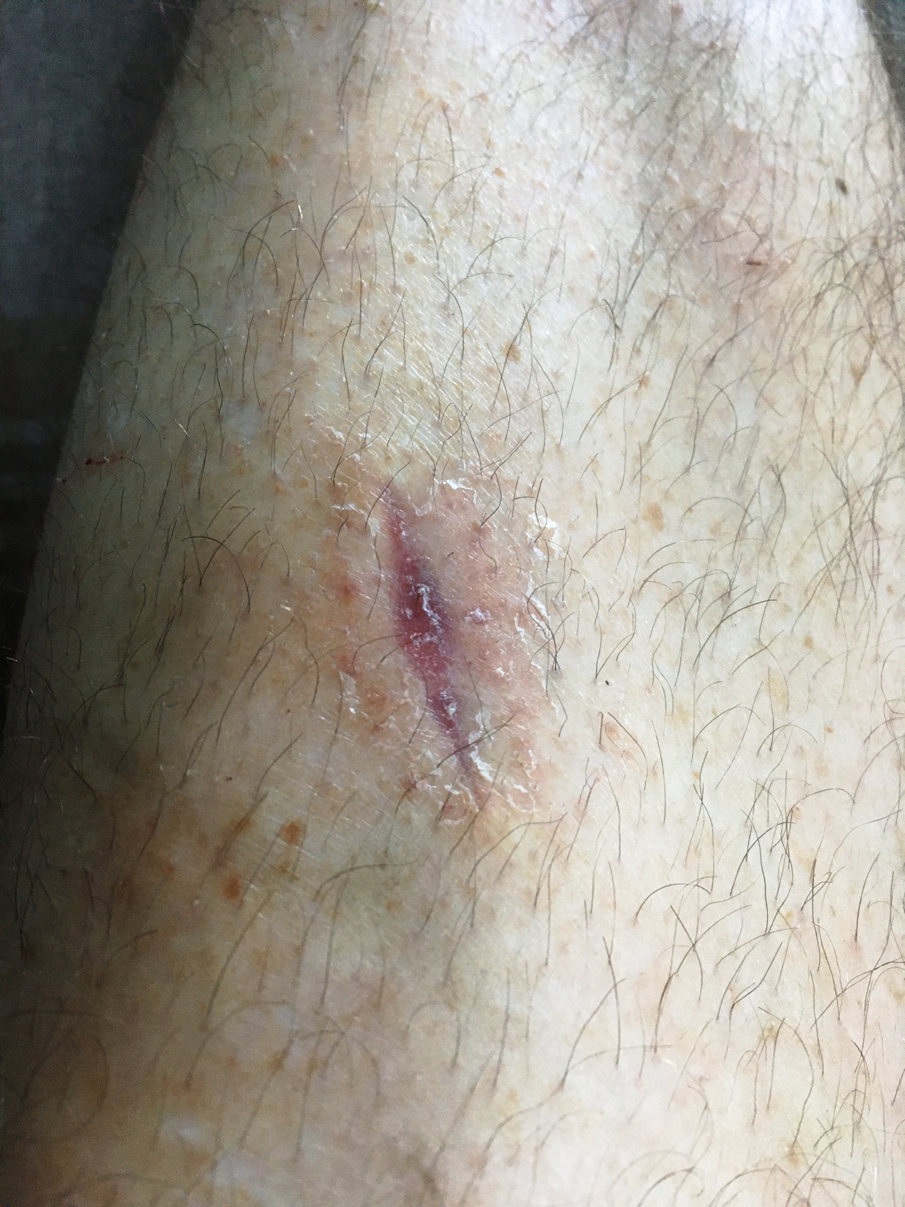Leg Scar